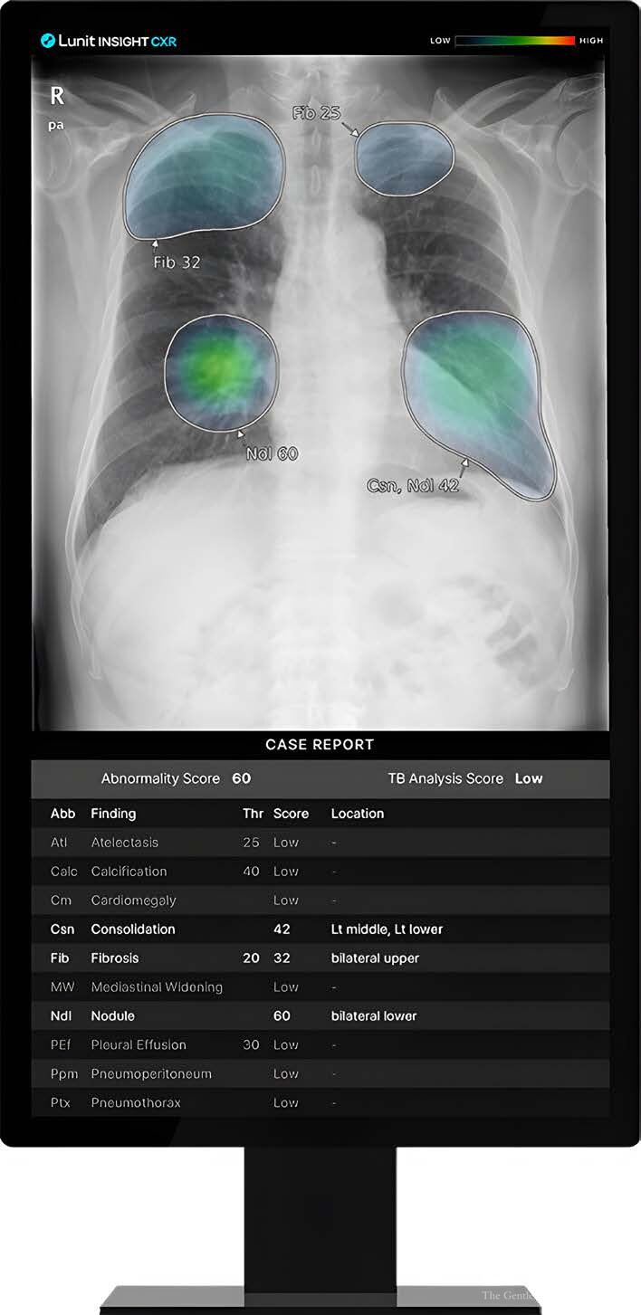 흉부 X-ray에서 가장 흔하게 발견되는&nbsp;10가지 비정상 소견을 진단·검출 보조하는 루닛인사이트 CXR<p>